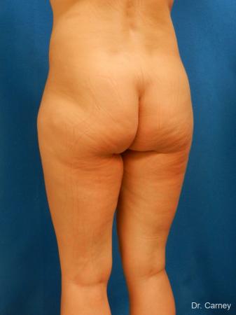 Brazilian Butt Lift: Patient 7 - Before Image 4