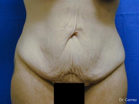 Virginia Beach Tummy Tuck 1249 - Before Image 2