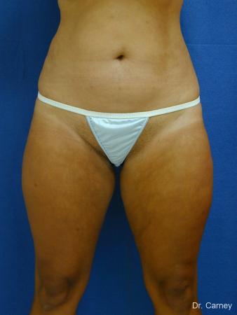 Virginia Beach Liposuction 1284 - After Image 1