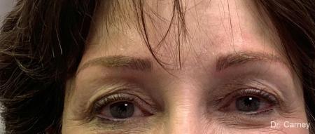 Microblading: Patient 3 - After Image 1