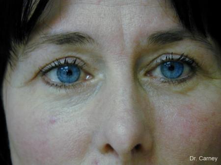 Virginia Beach Eyelid Lift 1139 - After Image 1