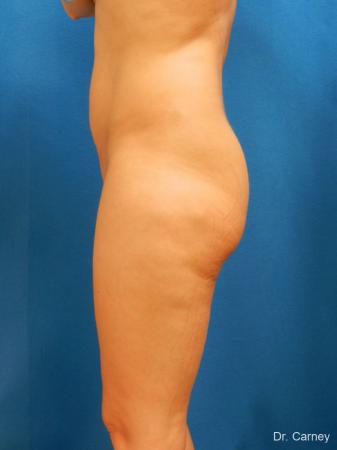 Brazilian Butt Lift: Patient 7 - Before and After Image 5
