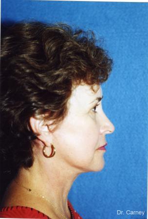 Virginia Beach Laser Skin Resurfacing - Face 1259 - After Image 2