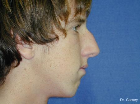 Virginia Beach Rhinoplasty 1219 - Before Image 4