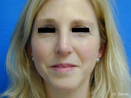 Virginia Beach Rhinoplasty 1343 - After Image 1