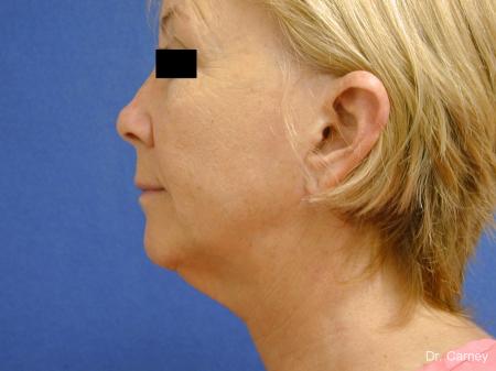 Virginia Beach Facelift 1262 - Before and After Image 5