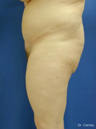 Virginia Beach Tummy Tuck 1250 - After Image 2