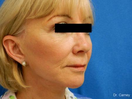 Virginia Beach Laser Skin Resurfacing Face 1263 - After Image 2