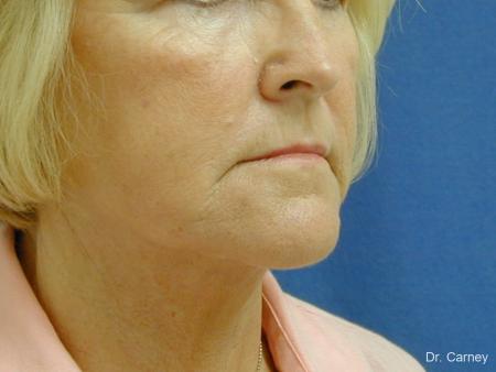 Virginia Beach Neck Lift 1207 - After Image 1
