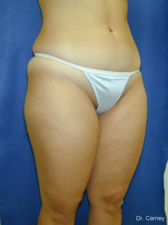 Virginia Beach Liposuction 1285 - Before Image 1
