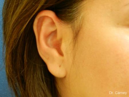Virginia Beach Otoplasty Earlobe Repair 1225 - After Image 1