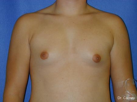 Virginia Beach Gynecomastia - Before Image 1