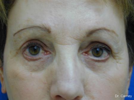 Virginia Beach Eyelid Lift 1128 - Before Image 1