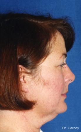 Virginia Beach Laser Skin Resurfacing - Face - Before and After Image 3