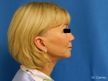 Virginia Beach Facelift 1262 - After Image 4