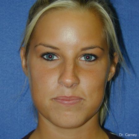 Virginia Beach Rhinoplasty 1218 - Before and After Image 5