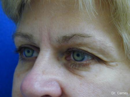 Virginia Beach Brow Lift 1345 - Before Image 3