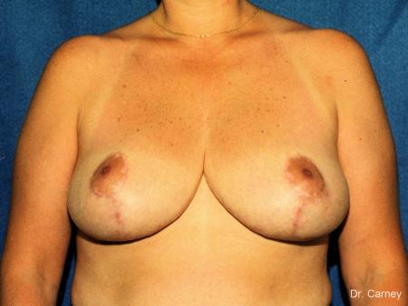 Virginia Beach Breast Reduction 1229 - After Image 1