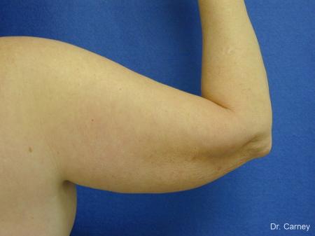 Virginia Beach Brachioplasty 1144 - Before Image 2