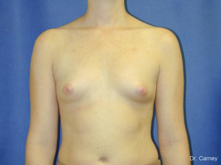 Virginia Beach Breast Augmentation 1090 - Before and After Image 3