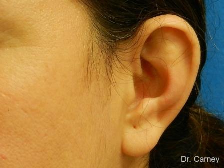Virginia Beach Otoplasty Earlobe Repair 1225 - Before and After Image 2