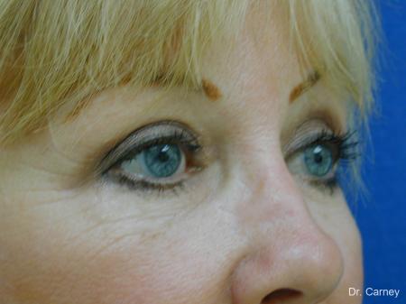 Virginia Beach Brow Lift 1266 - After Image 2