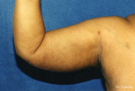 Virginia Beach Brachioplasty 1142 - After Image 1