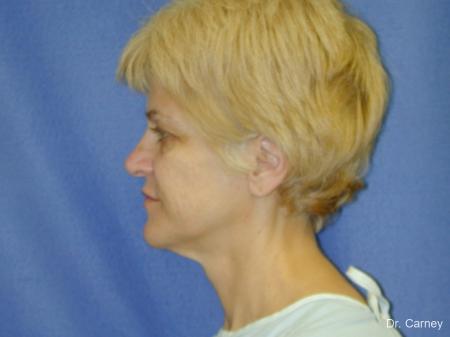 Virginia Beach Facelift 1346 - Before Image 4
