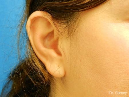 Virginia Beach Otoplasty Earlobe Repair 1225 - Before Image 1