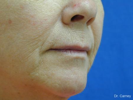 Virginia Beach Laser Skin Resurfacing Face 1263 - Before Image 3