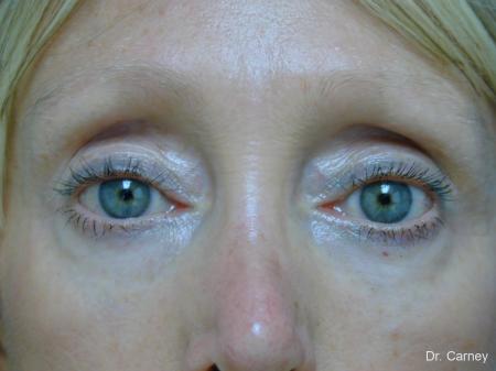 Virginia Beach Eyelid Lift 1079 - After Image 1