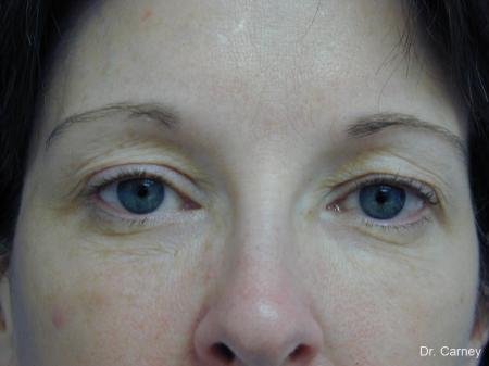 Virginia Beach Brow Lift 1217 - Before Image 2