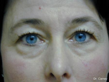 Virginia Beach Eyelid Lift 1139 - Before Image 1