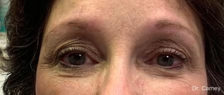 Microblading: Patient 3 - Before Image 1