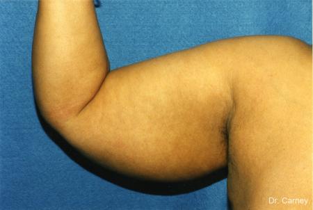 Virginia Beach Brachioplasty 1142 - Before Image 1