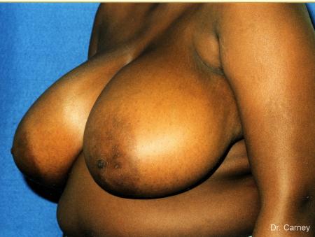 Virginia Beach Breast Reduction 1233 - Before Image 1