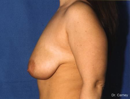 Virginia Beach Breast Lift 1187 - Before and After Image 2