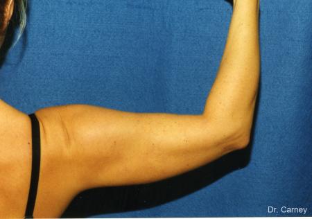 Virginia Beach Brachioplasty 1141 - After Image 2