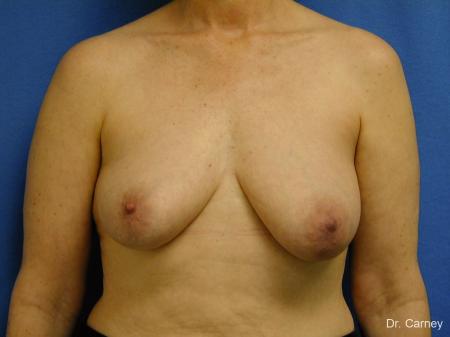 Virginia Beach Breast Lift 1185 - Before Image 1