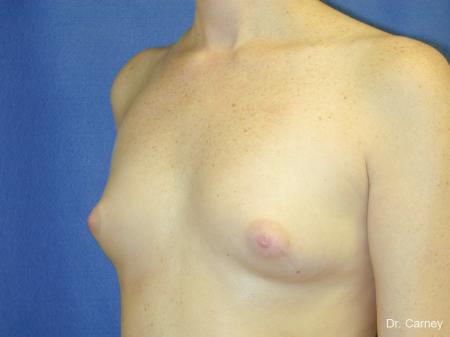 Virginia Beach Breast Augmentation 1090 - Before Image 2