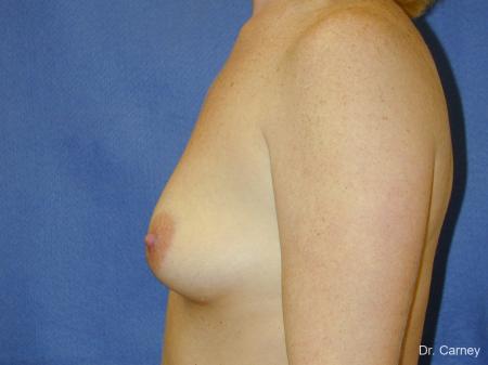 Virginia Beach Combo Procedures Breast 1098 - Before Image 1