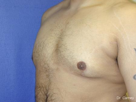 Virginia Beach Gynecomastia 1255 - After Image 5