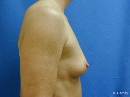 Virginia Beach Breast Augmentation 1214 - Before Image 3