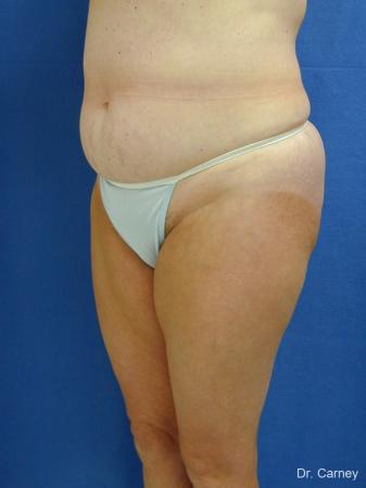 Virginia Beach Liposuction 1213 - Before Image 1