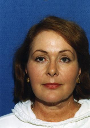 Virginia Beach Laser Skin Resurfacing - Face - After Image 2