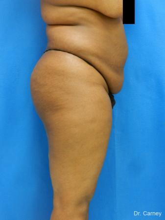 Brazilian Butt Lift: Patient 4 - Before and After Image 5