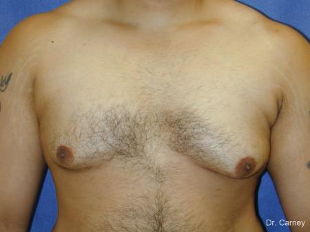 Virginia Beach Gynecomastia 1255 - Before Image 1