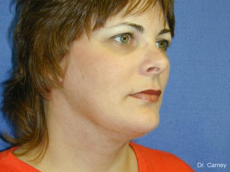 Virginia Beach Neck Lift 1269 - After Image 2