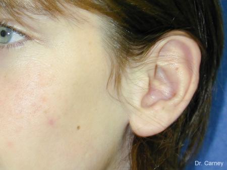 Virginia Beach Otoplasty Earlobe Repair 1271 - Before Image 3