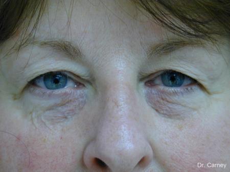 Virginia Beach Eyelid Lift 1129 - Before Image 1